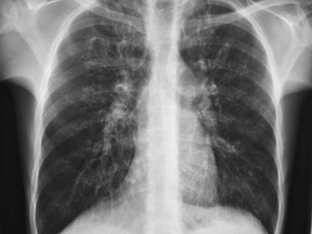 23-year-old female with cystic fibrosis should be considered ASA IV