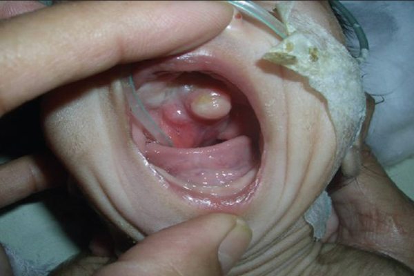 Oral Teratoma