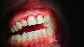 gum disease