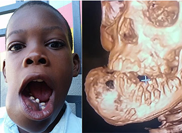 John “Little John” Olivier, age 9, who was inflicted with a life-threatening oral tumor