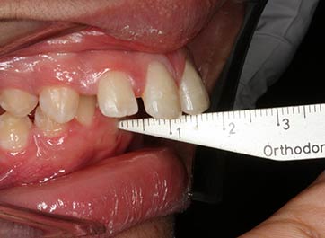 Protruding Teeth