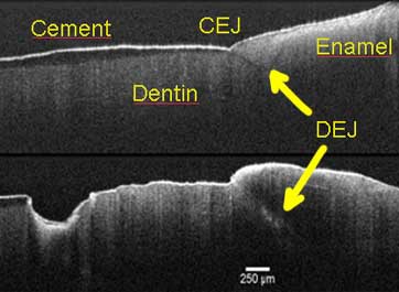 Promising Imaging Method for the Early Detection of Dental Caries