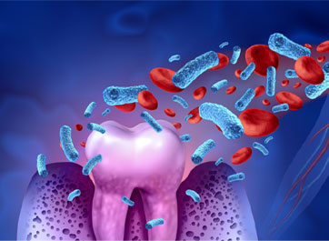 Certain Oral Bacteria Linked to Hypertension in Postmenopausal Women