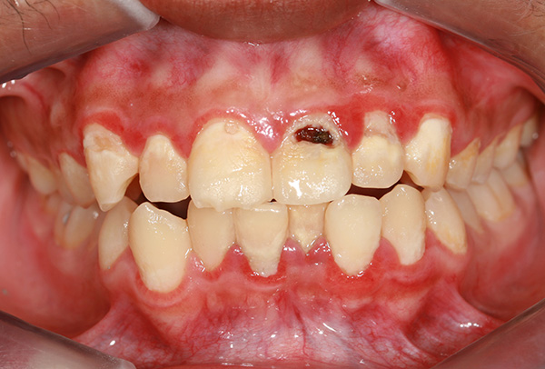 Oral Cancer Risk may be Increased by Gum Disease Bacteria