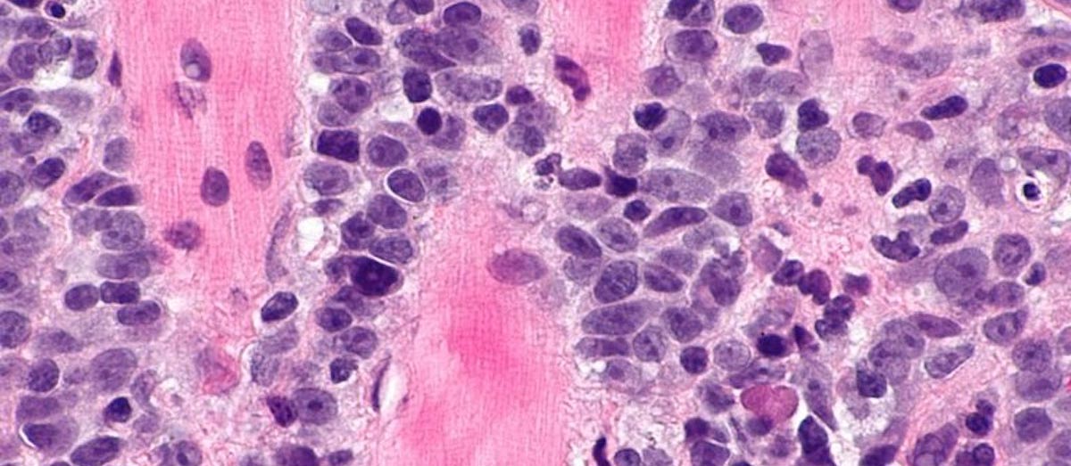 HPV-associated squamous cell carcinoma. Photo from Wikimedia Commons.