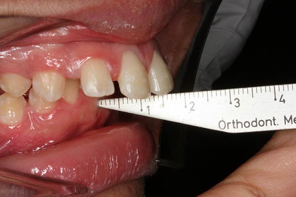 Even a Comparatively Mild Overjet Can Increase the Risk of Dental Trauma in Children