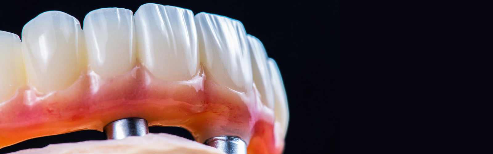 Perfected Full Arch Dental Implant Workflow