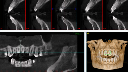 CBCT Scan