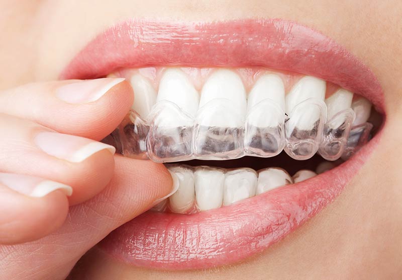 Do-It-Yourself Teeth Whitening is a  Multi-Billion Business