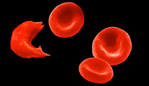 Does sickle-cell anemia complicate sedation procedures?
